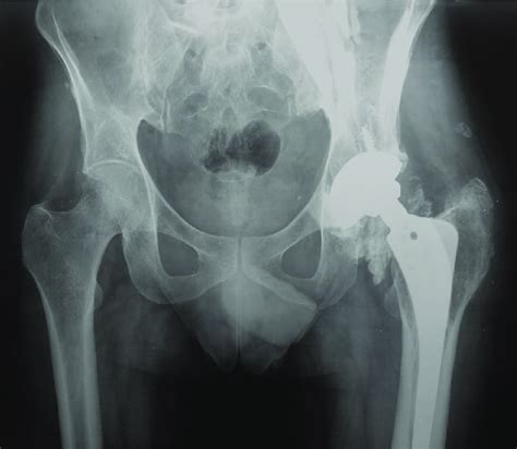 X Ray Both Hips With Pelvis Showing Severe Osteolysis And Ill Defined
