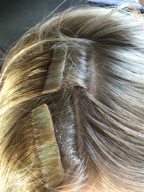 When hair extensions are first fitted, many do not truly understand the importance of correct aftercare, and therefore this is quite a common cause of symptoms such as itchiness or scalp finding the correct aftercare routine for your hair extensions can often resolve issues such as itchiness. Hair extensions making scalp itch and red marks! Help!