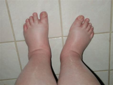 Swollen Feet Causes Symptoms Treatment Self Remedy Pictures