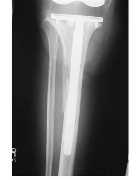 An Anteroposterior Radiograph Shows The Tibia Of The Same Knee As In