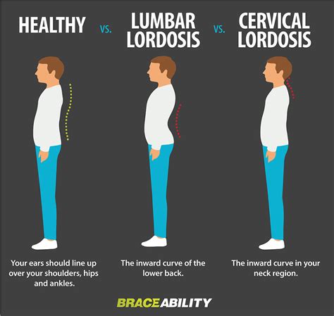 What Is Lordosis Lumbar And Cervical Swayback Or Curved Spine