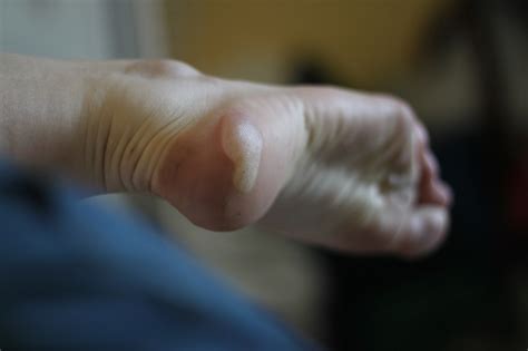 Blisters And Calluses Inside Your Body Stop Everyday Pain®