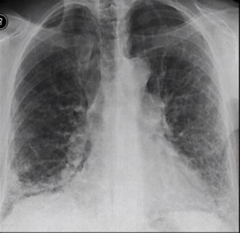 Interstitial Lung Disease X Ray