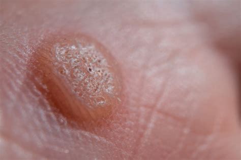 Verrucae And Warts Overview And Treatments Evolution Podiatry