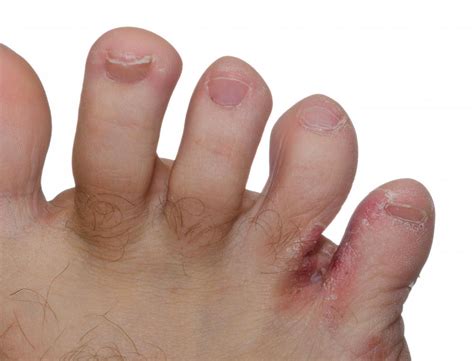 What Are The Causes Of Red Itchy Feet With Pictures