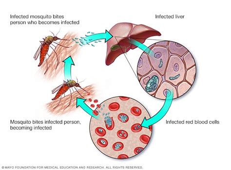 Malaria Symptoms And Causes Mayo Clinic