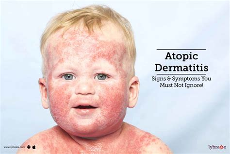 Atopic Dermatitis Signs And Symptoms You Must Not Ignore By Dr Gagandeep Singh Ahuja Lybrate