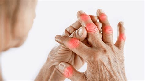 Different Stages Of Rheumatoid Arthritis 4 Stages