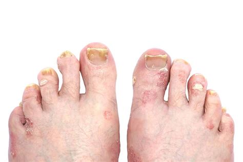 Psoriasis And Psoriatic Arthritis Of The Toe Nails And Feet A Step