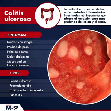 Colitis Ulcerosa Síntomas Y Tipos
