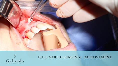 Full Mouth Gingival Improvement Youtube