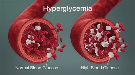Hyperglycemia Symptoms Causes Complications And Treatment Scientific Animations