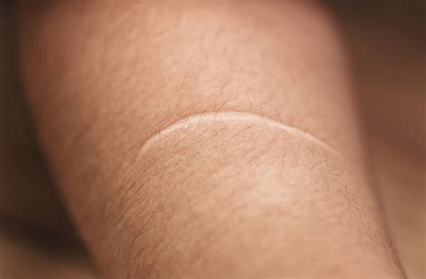 Being Older Helps Skin Heal With Less Scarring And Now Researchers Know Why Penn Medicine