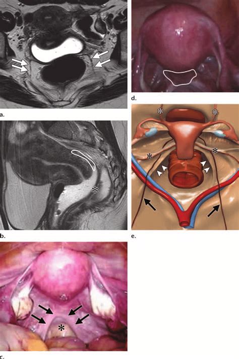 Pelvic Anatomy Female Ligaments Surgical Anatomy Of The Female Pelvis By Laparoscopy Related