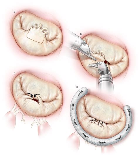 Minimally Invasive And Robot Assisted Mitral Valve Surgery Adult And