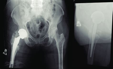 Anteroposterior Pelvis And Lateral Hip Radiographs Following Revision
