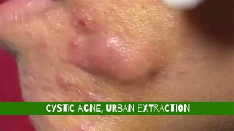 Cystic Acne Urban Extraction Youtube