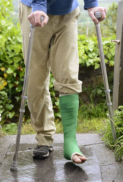 Broken Ankle And Crutches Stock Image C0213108 Science Photo Library