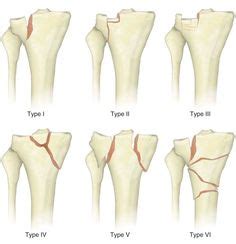 Tibial plateau fractures may be associated with injury to nearby structures including vasculature, nerves, ligaments, menisci, and adjacent compartments. Pin on tibial plateau fracture left