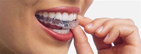 Les Appareils Dentaires En Orthodontie Guide Complet Du Dr Asselborn