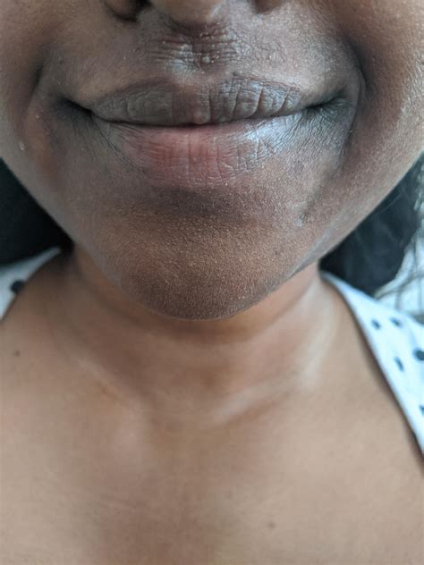 Skin Concern Any Tips For Cracked Wrinkly Eczema Rskincareaddiction