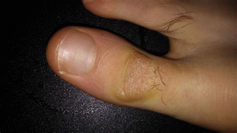 Help Identifying Toe Skin Problem Skin And Face 152016 2295479