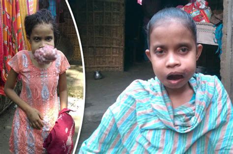 Massive Mouth Tumour Leaves Teenage Girl Struggling To Eat And Breathe
