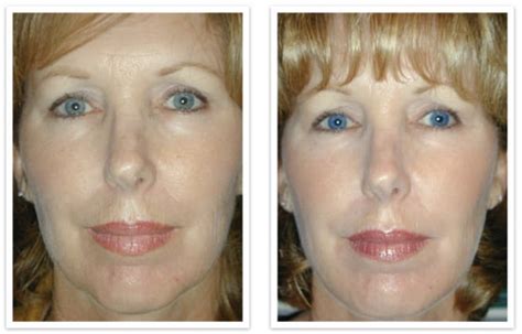 Can Jowls Be Fixed Without Surgery Non Surgical Jowl Lift Dr Adam