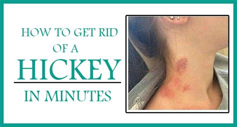 How To Get Rid Of Hickey In Minutes 10 Diy Methods Remedies Lore