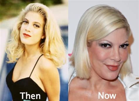 Tori Spelling Before And After Plastic Surgery