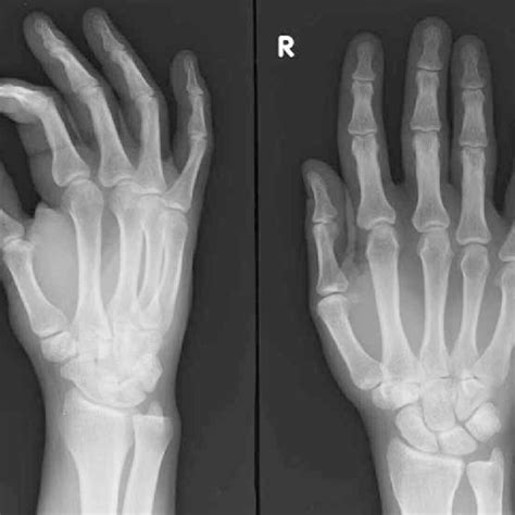 Plain X Rays Of The Hand Oblique And Pa View Fail To Reveal The