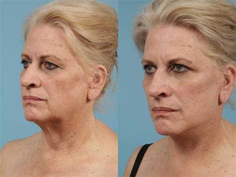 Faceliftminilift By Dr Mustoe Before And After Pictures Case 155 Chicago Il Tlkm Plastic