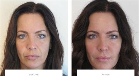 How Long After Botox Can You Get A Facial Facial Adviser