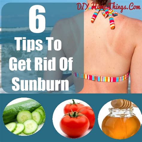 See full list on wikihow.com 6 Tips To Get Rid Of Sunburn | DIY Home Things