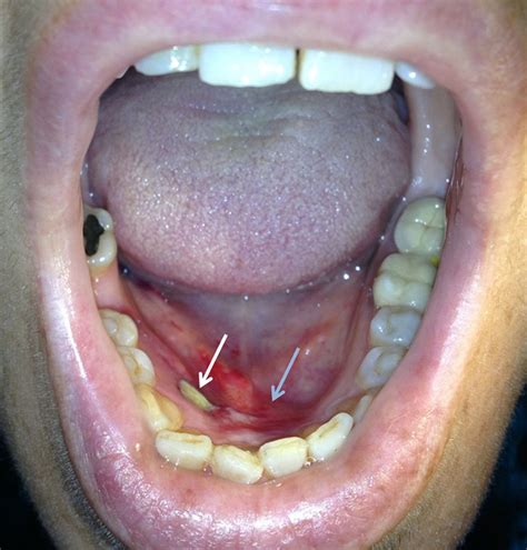 white spot on floor of mouth under tongue