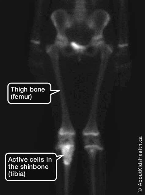 Bone Scan And Cancer Diagnosis