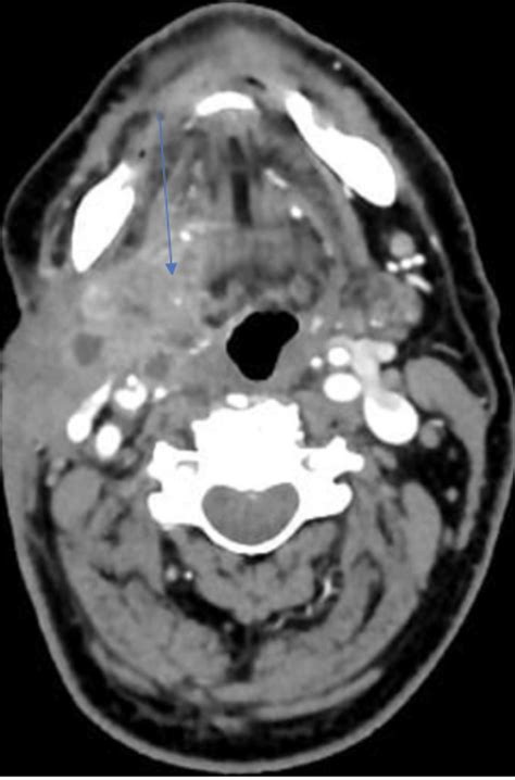 Scannographic Presentation Of The Right Submandibular Mass Showing High