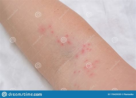 Skin Rash On Female Arm Itchy Pimples As A Result Of An Allergic
