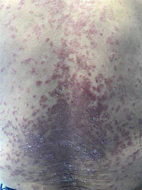 Erythematous Pruritic Plaques Page Of Clinical Advisor