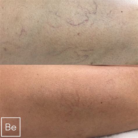 Spider Vein Removal With Yag Laser Rochester Ny Bare Element