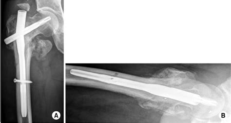 Failure Of The Proximal Femoral Nail Antirotation Through The Insertion