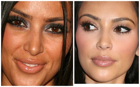 Kim Kardashian Before And After Nose Job Kardashian Plastic Surgery