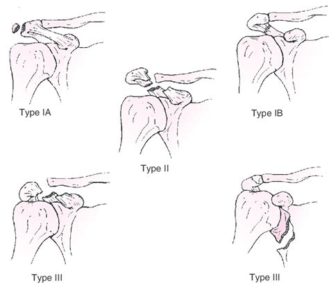 Kuhns Classification Of Fractures Of The Acromion Process Type I