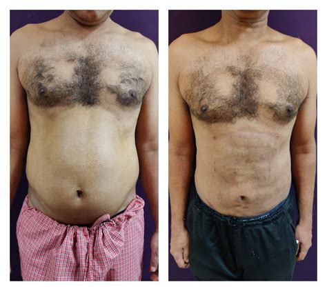 Liposuction In Abdomen Abdominal Surgery At Venkat Center