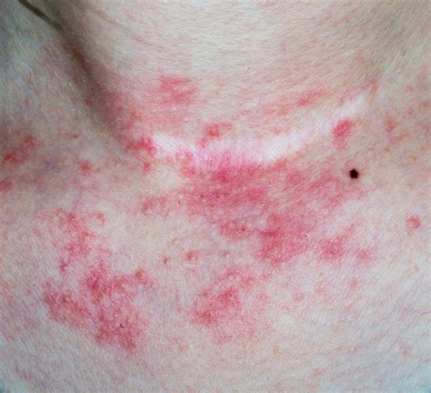 Types Of Eczema Painscale