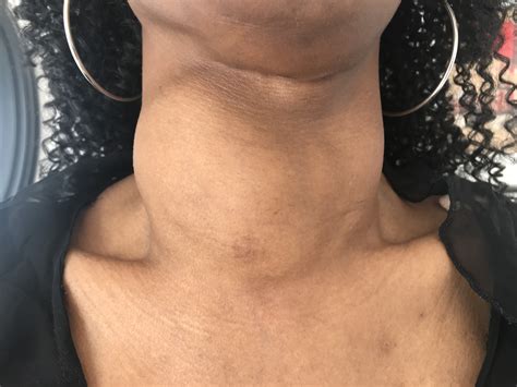 Thyroid Nodules And Goiters No Surgery For Benign Goiter Nodules