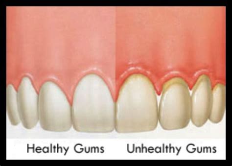 Healthy Gums Vs Gingivitis Gum Recession Gums Gingival Receding Dental