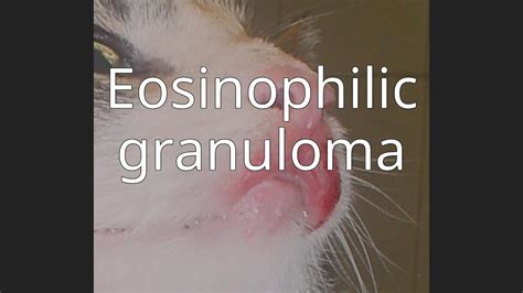 Eosinophilic Granuloma Youtube