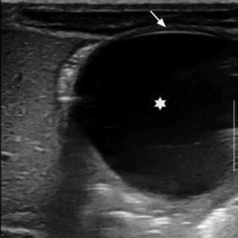 Gastric Duplication Cyst Ultrasound Us Of Abdomen Shows A