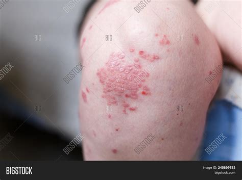Allergic Rash Image And Photo Free Trial Bigstock